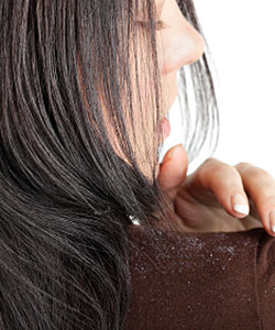 dandruff problems