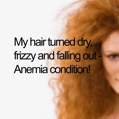 My hair turned dry, frizzy and falling out - Anemia condition!