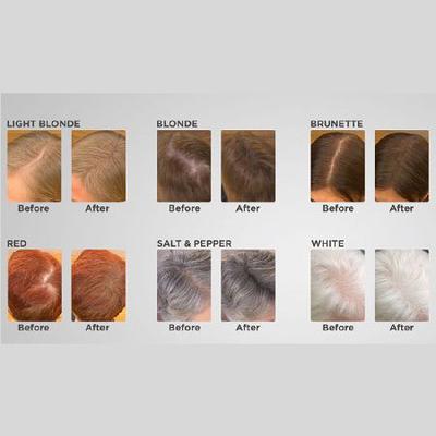 Thin Fine Hair - Visible Scalp Thin Fine Hair - Visible Scalp