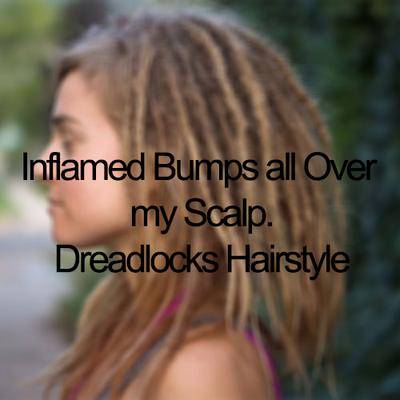 Inflamed Bumps All Over My Scalp Dreadlocks Hairstyle